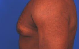 Gynecomastia Surgery Before & After Image