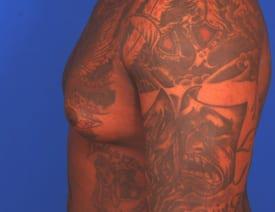 Gynecomastia Surgery Before & After Image