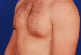 Gynecomastia Surgery Before & After Image