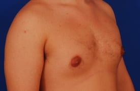 Gynecomastia Surgery Before & After Image