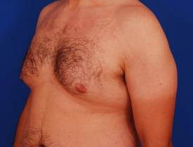 Gynecomastia Surgery Before & After Image