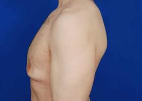 Gynecomastia Surgery Before & After Image