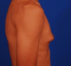 Gynecomastia Surgery Before & After Image