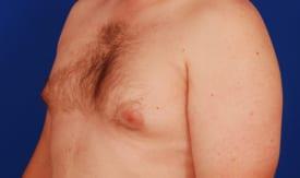Gynecomastia Surgery Before & After Image