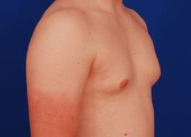 Gynecomastia Surgery Before & After Image