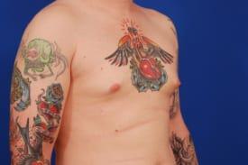 Gynecomastia Surgery Before & After Image