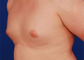 Gynecomastia Surgery Before & After Image