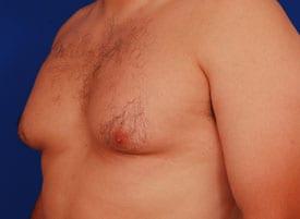 Gynecomastia Surgery Before & After Image