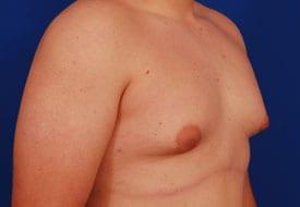 Gynecomastia Surgery Before & After Image