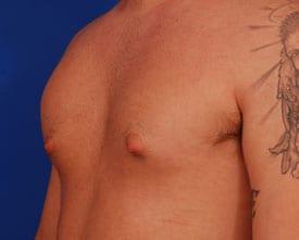 Gynecomastia Surgery Before & After Image