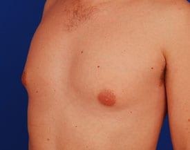 Gynecomastia Surgery Before & After Image