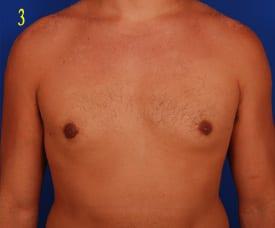 Gynecomastia Surgery Before & After Image