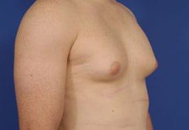 Gynecomastia Surgery Before & After Image