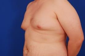Gynecomastia Surgery Before & After Image