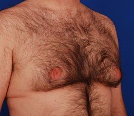 Gynecomastia Surgery Before & After Image