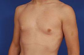 Gynecomastia Surgery Before & After Image