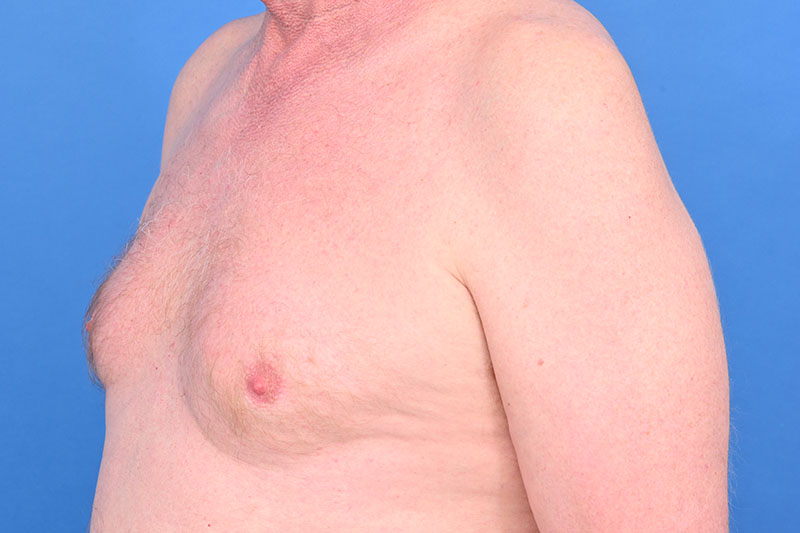 Gynecomastia Surgery Before & After Image