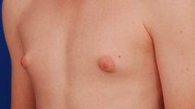 Gynecomastia Surgery Before & After Image