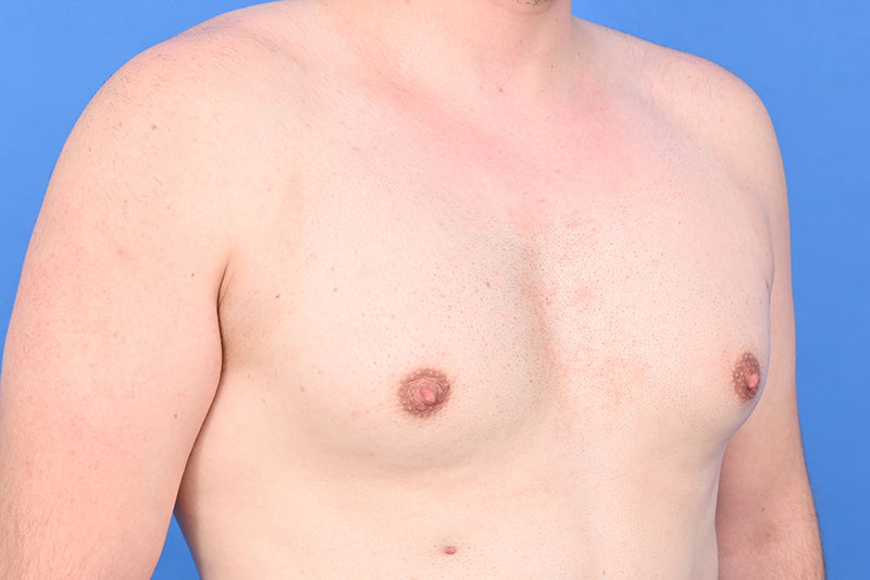 Gynecomastia Surgery Before & After Image
