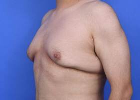 Before Austin Gynecomastia Surgery patient