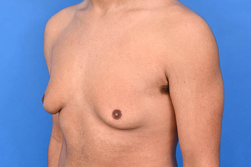 Gynecomastia Surgery Before & After Image