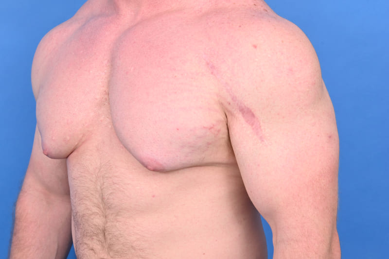 Gynecomastia Surgery Before & After Image