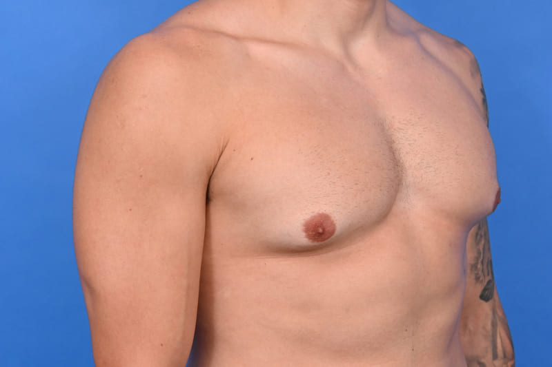 Gynecomastia Surgery Before & After Image