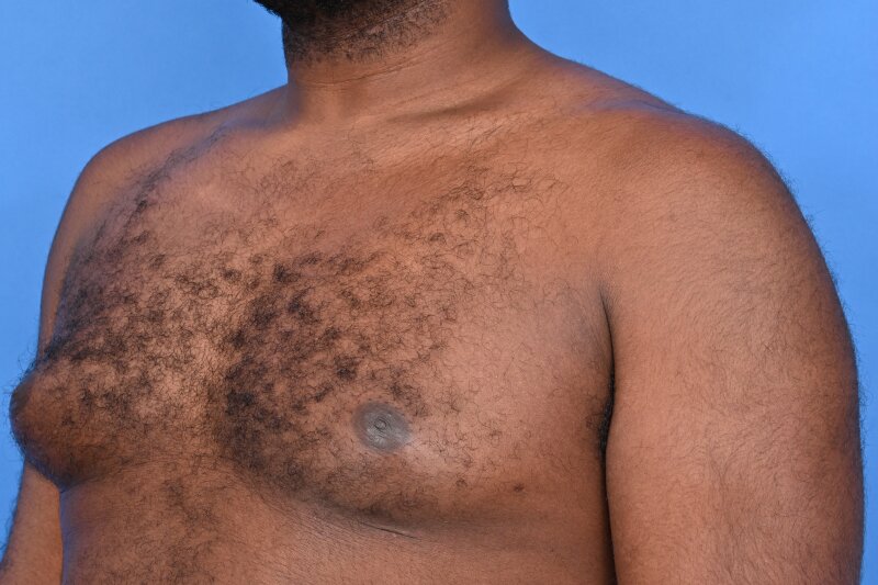 Gynecomastia Surgery Before & After Image