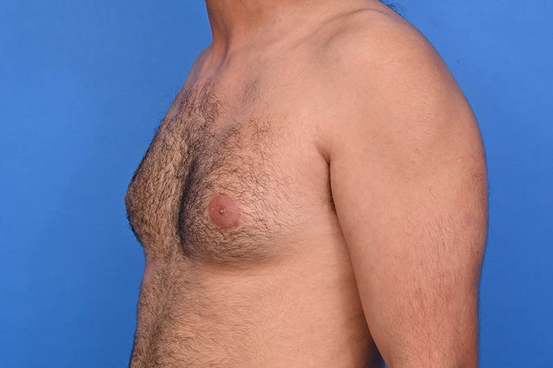 Gynecomastia Surgery Before & After Image