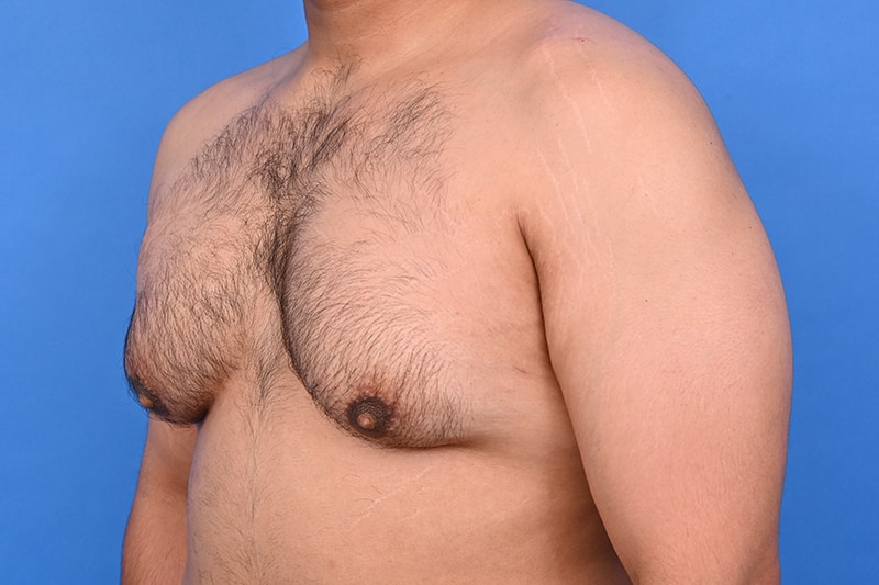 Gynecomastia Surgery Before & After Image