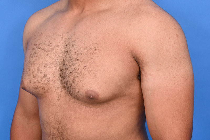Gynecomastia Surgery Before & After Image