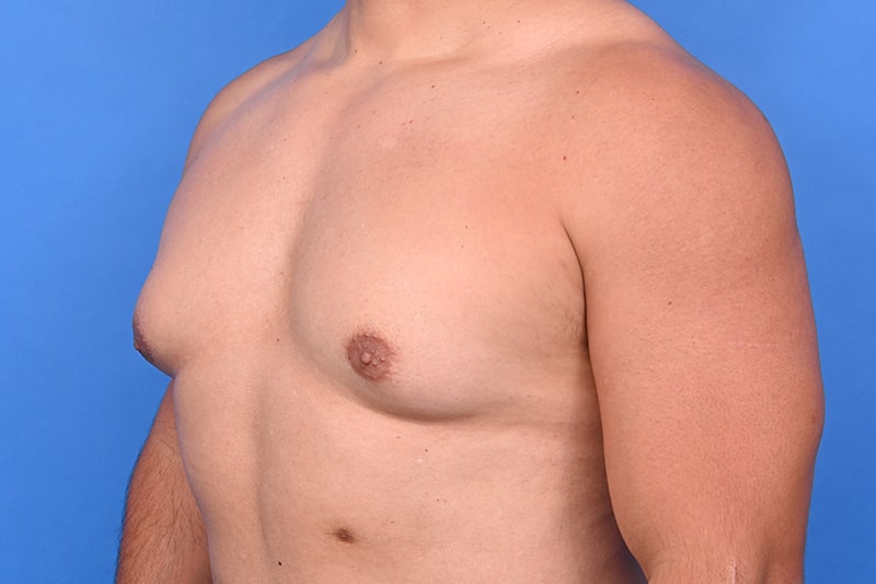Gynecomastia Surgery Before & After Image