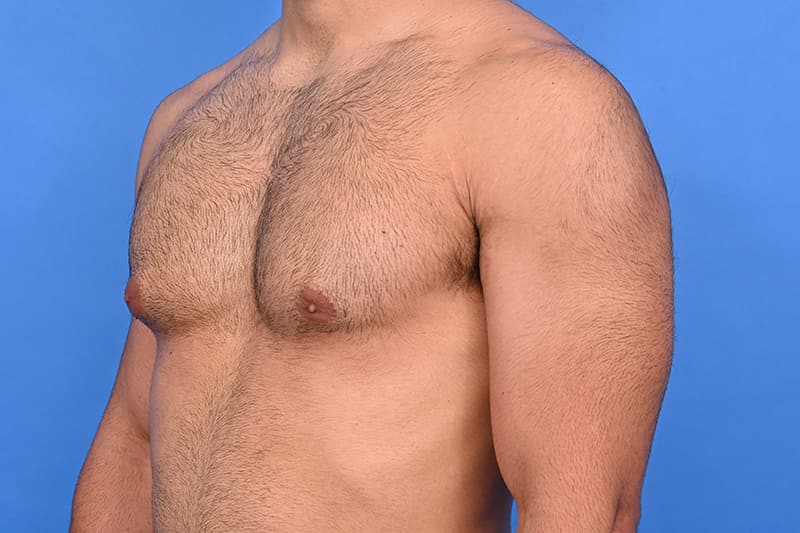 Gynecomastia Surgery Before & After Image