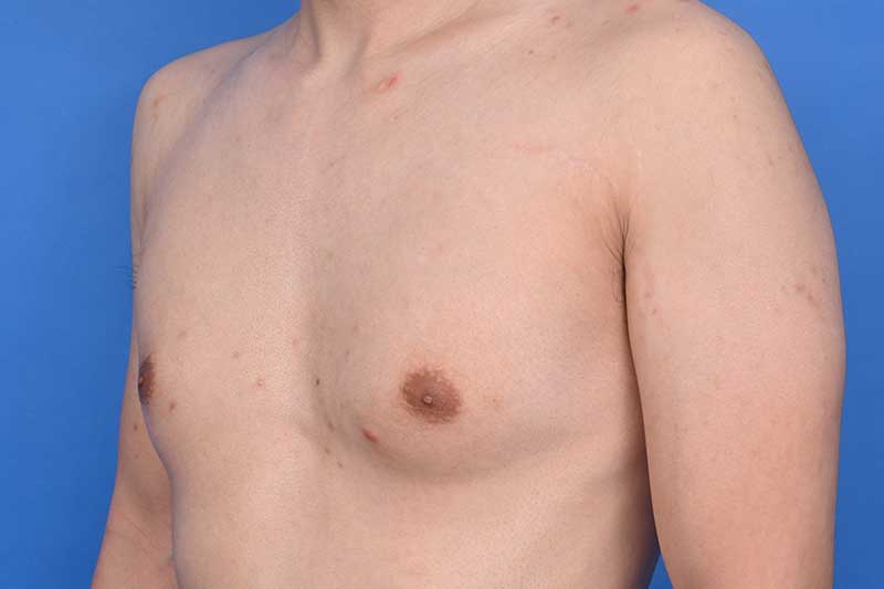 Gynecomastia Surgery Before & After Image