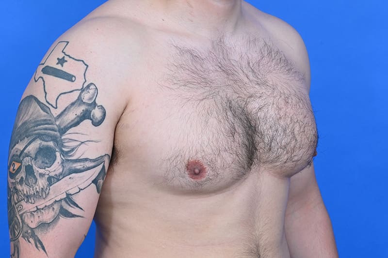 Gynecomastia Surgery Before & After Image
