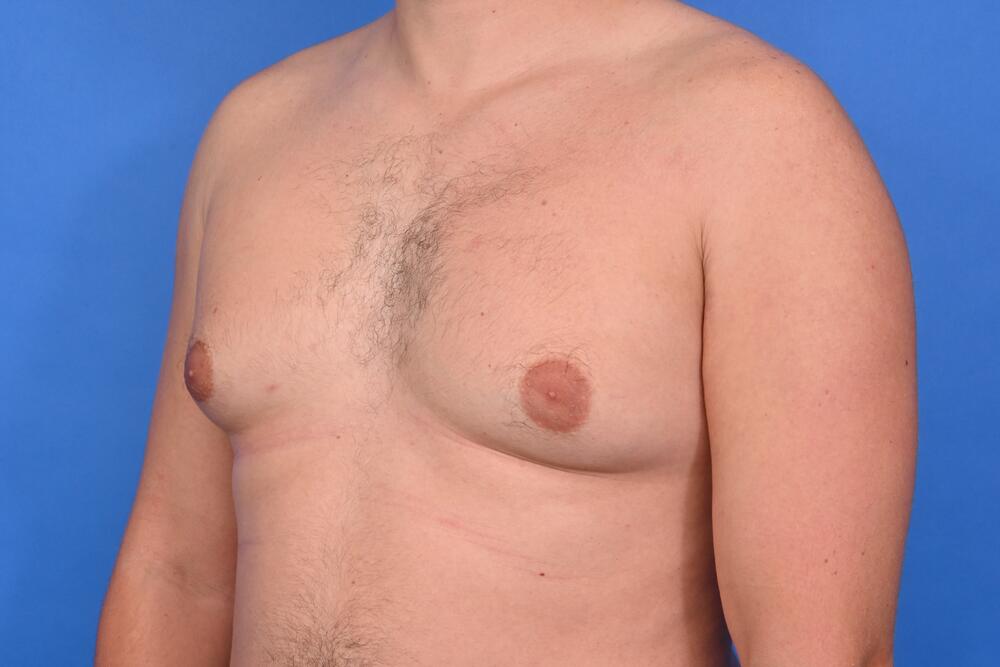 Gynecomastia Surgery Before & After Image