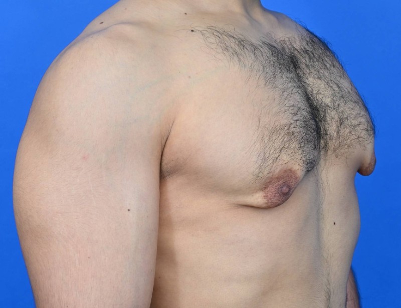 Gynecomastia Surgery Before & After Image