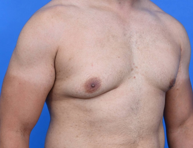 Gynecomastia Surgery Before & After Image