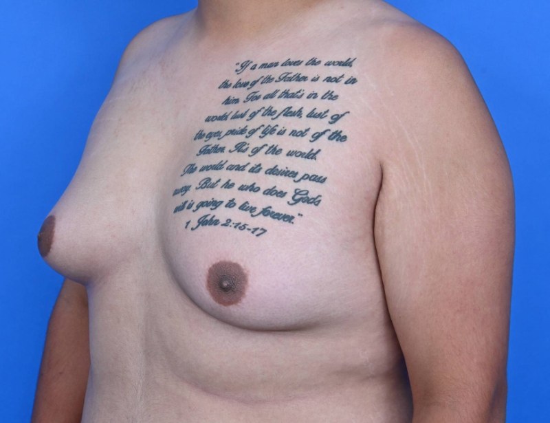 Gynecomastia Surgery Before & After Image
