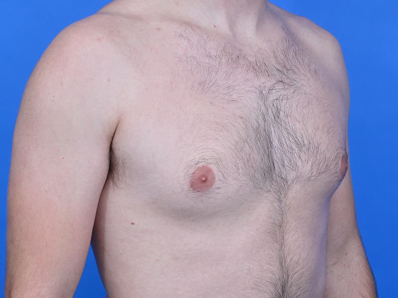 Gynecomastia Surgery Before & After Image