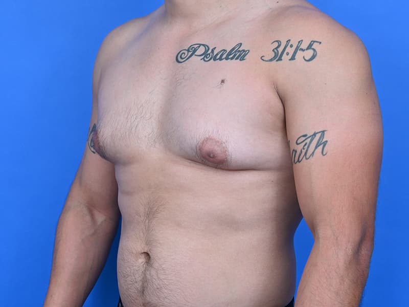 Gynecomastia Surgery Before & After Image