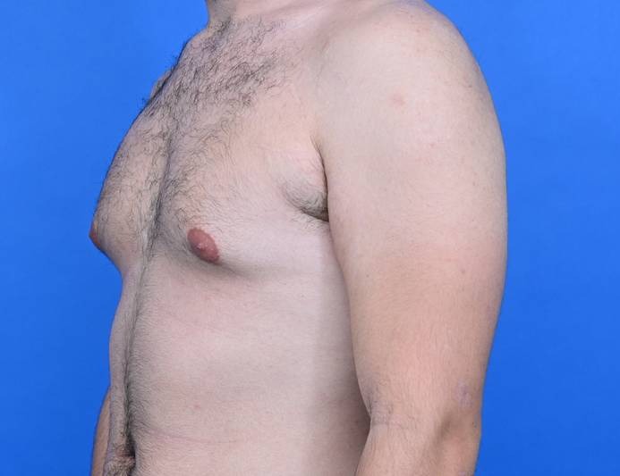 Gynecomastia Surgery Before & After Image