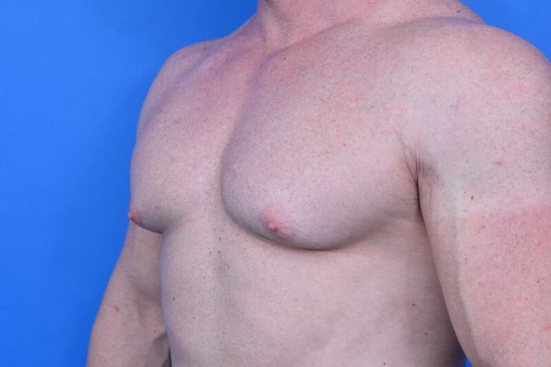 Gynecomastia Surgery Before & After Image