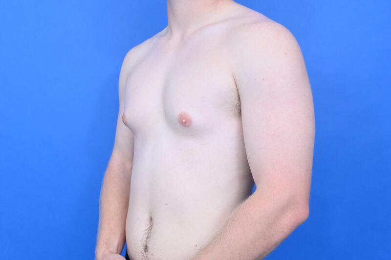 Gynecomastia Surgery Before & After Image