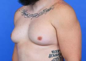 Gynecomastia Surgery Before & After Image