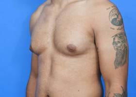 Gynecomastia Surgery Before & After Image