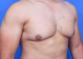Gynecomastia Surgery Before & After Image