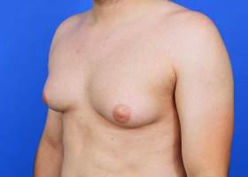 Gynecomastia Surgery Before & After Image