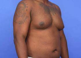Gynecomastia Surgery Before & After Image
