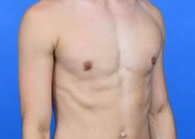 Gynecomastia Surgery Before & After Image